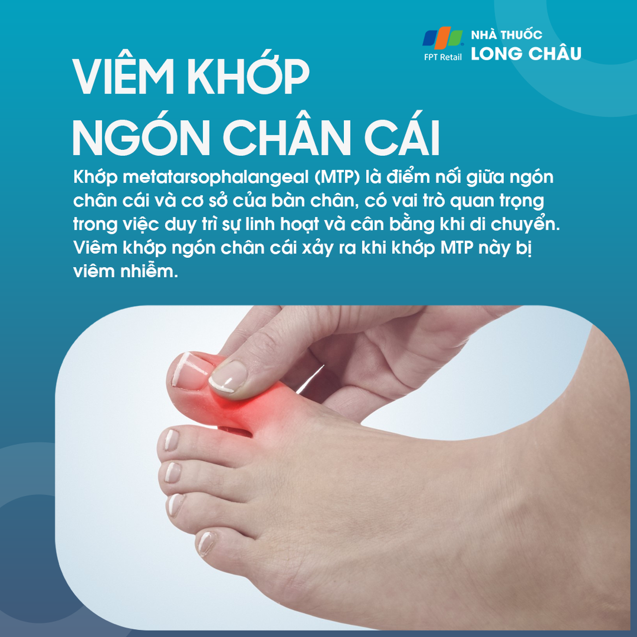 Viêm khớp ngón chân cái 1