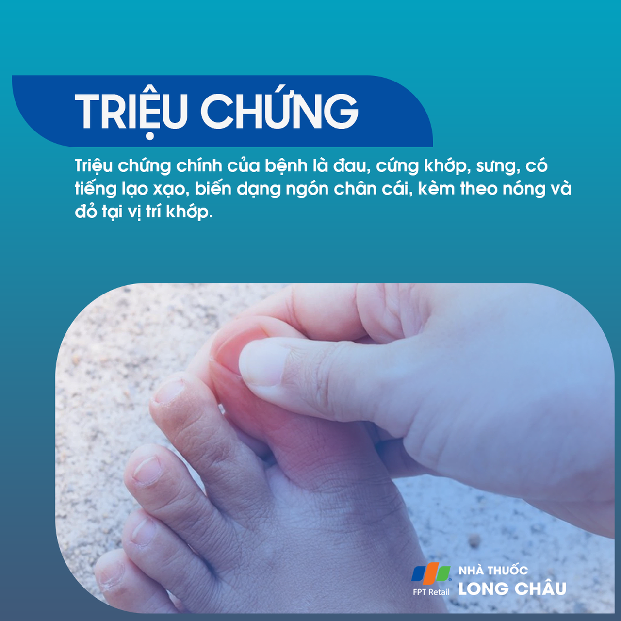 Viêm khớp ngón chân cái 2