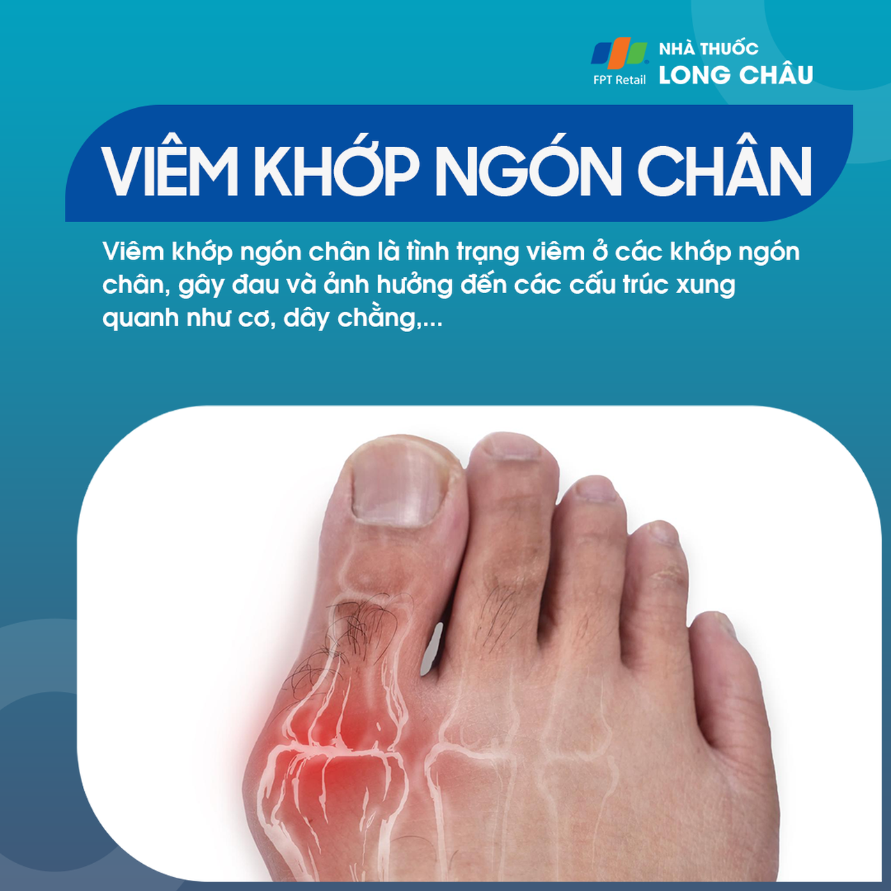 Viêm khớp ngón chân 1