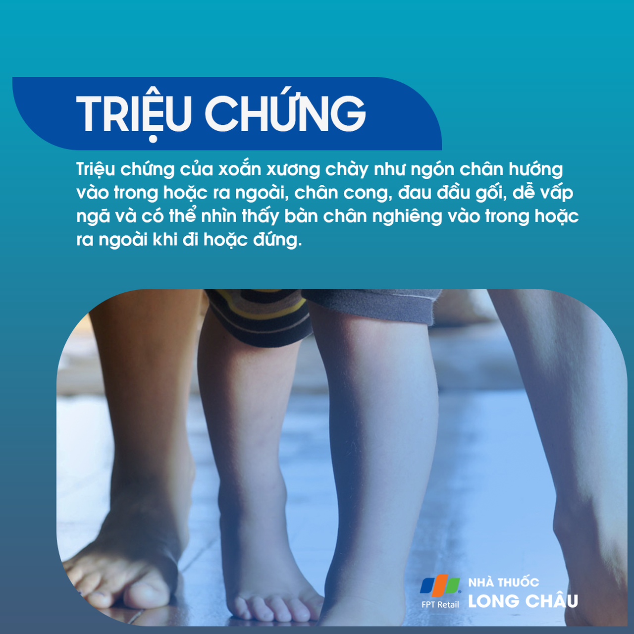 Xoắn xương chày 2