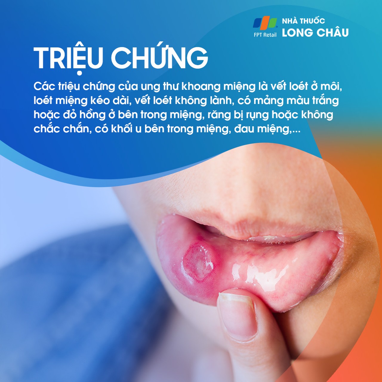 Ung thư khoang miệng 2