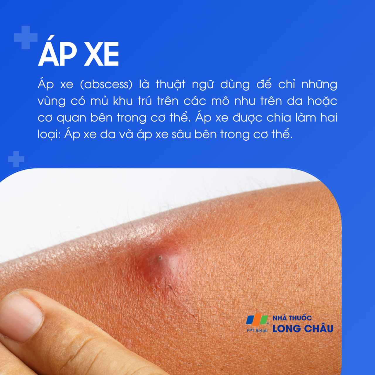 Áp xe là tình trạng tụ mủ khu trú ở mô mềm hoặc cơ quan bên trong cơ thể