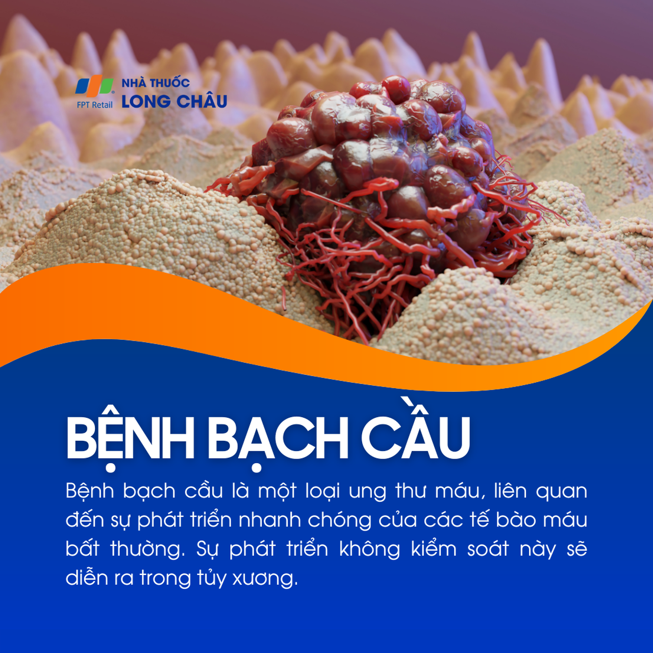 Bệnh bạch cầu là ung thư máu do sự phát triển bất thường và mất kiểm soát của tế bào máu trong tủy xương.