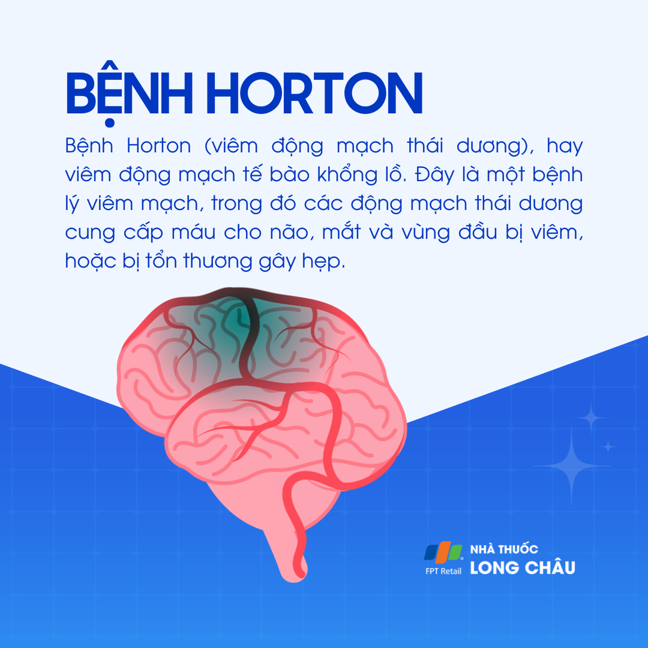 Bệnh horton 1