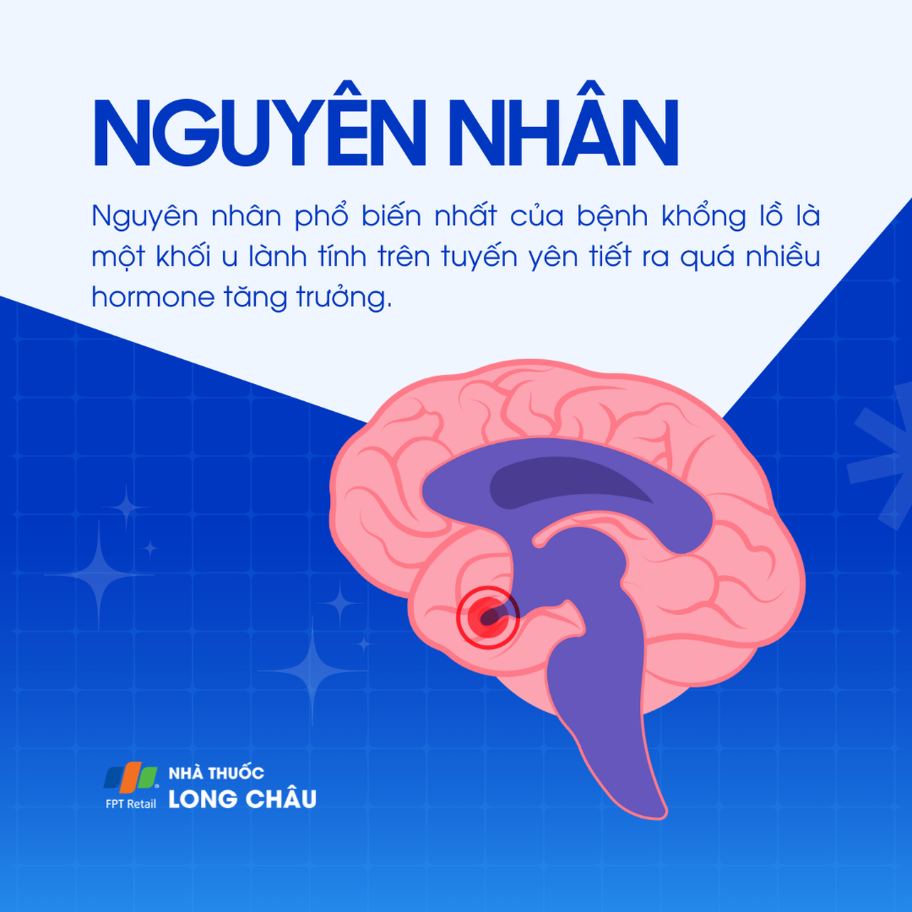 Bệnh khổng lồ 3