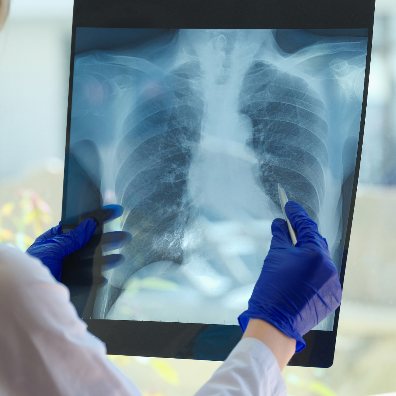 Bệnh lao là gì? Những vấn đề cần biết về bệnh lao 3