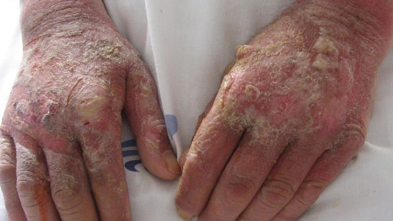 Bệnh Pellagra là bệnh gì? Một số điều cần biết về bệnh Pellagra 2