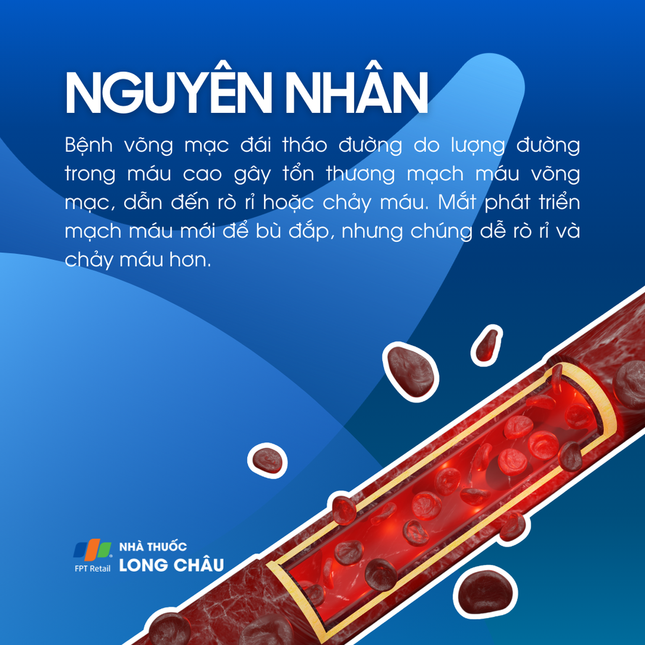 Bệnh võng mạc tiểu đường 3