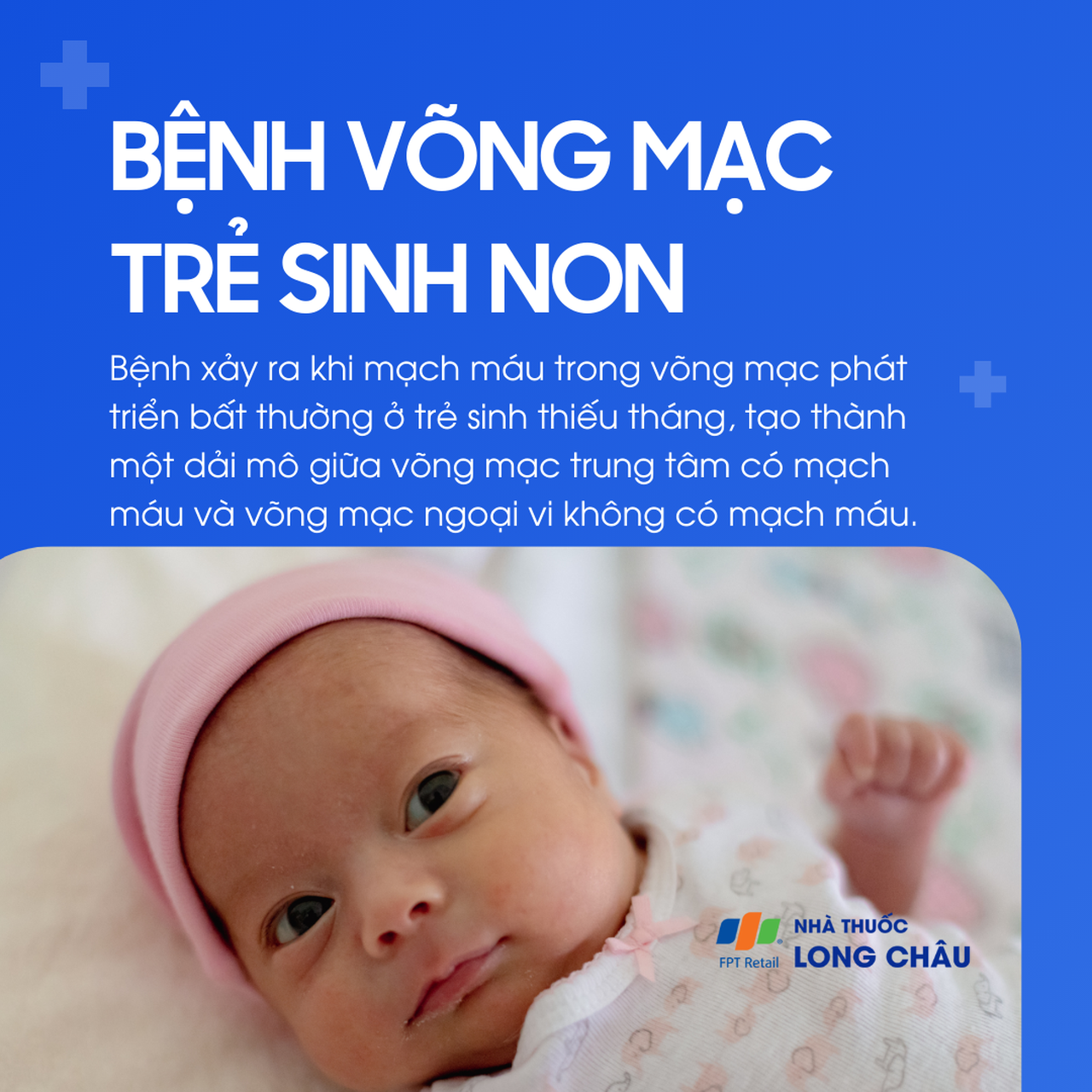 Bong võng mạc trẻ sinh non 1