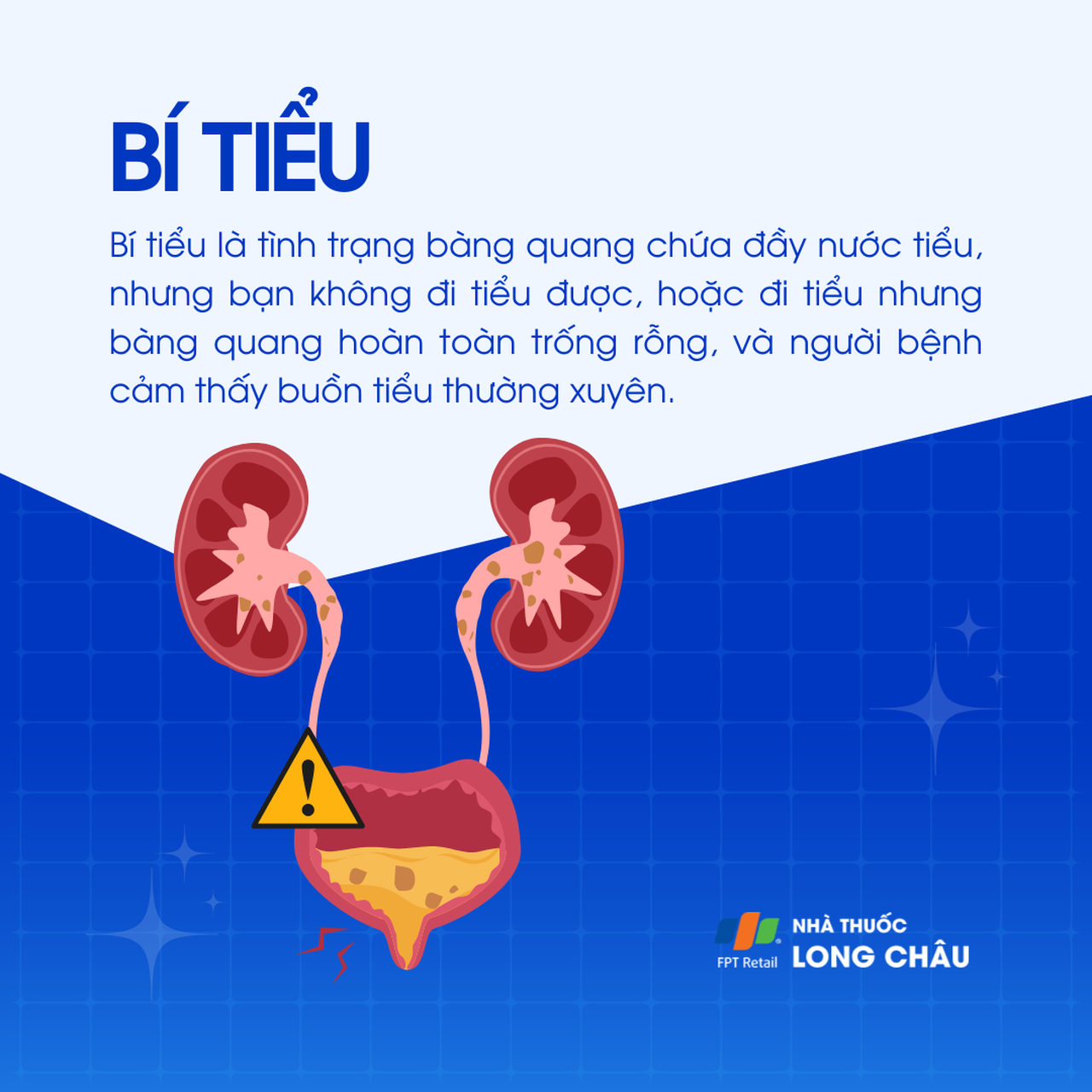 Bí tiểu: Là tình trạng bàng quang chứa đầy nước tiểu nhưng không đi tiểu được, hoặc đi tiểu xong vẫn còn tồn đọng nước tiểu