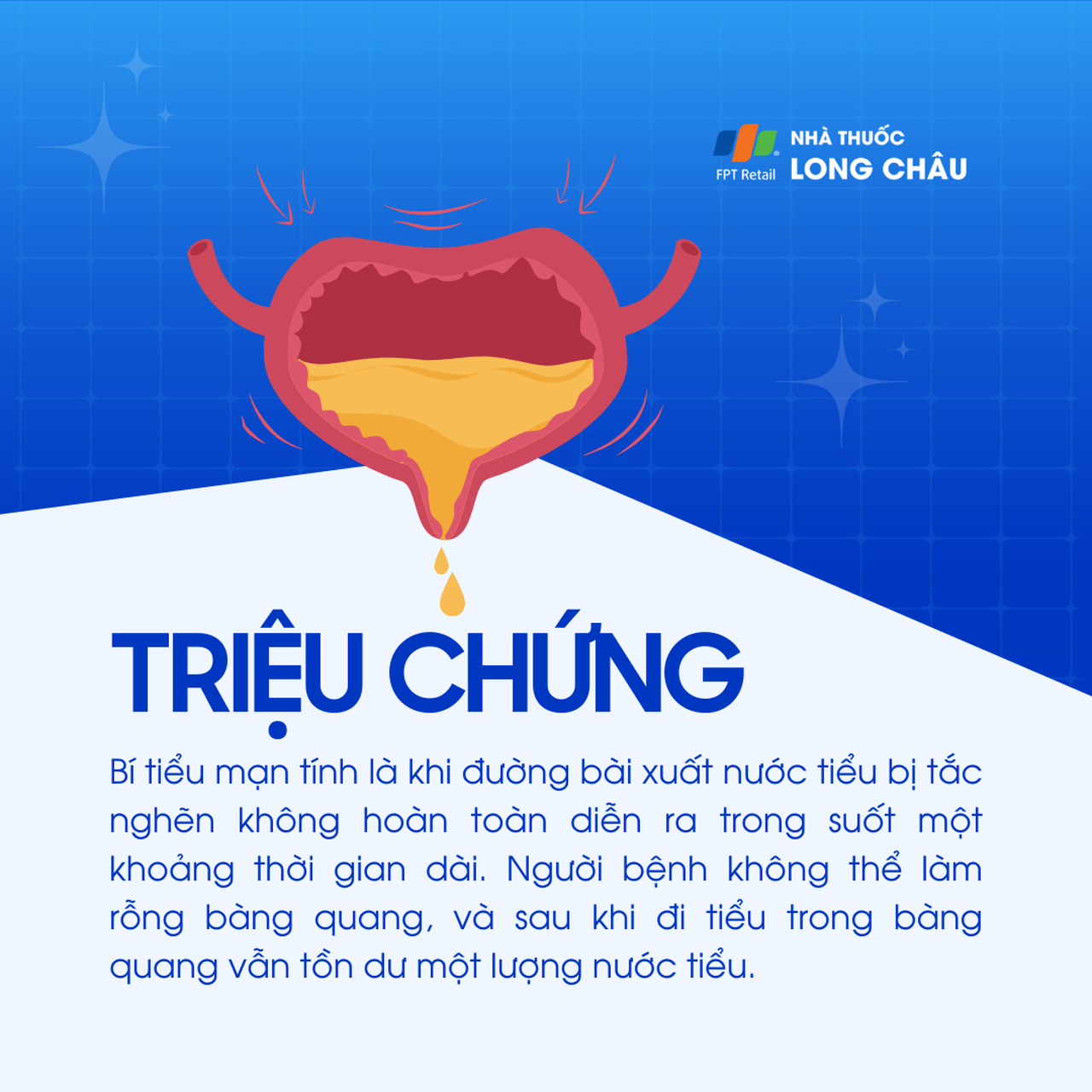 Triệu chứng mạn tính: Đường tiểu bị tắc nghẽn kéo dài, bàng quang không rỗng hoàn toàn, sau khi đi tiểu vẫn còn nước tiểu tồn dư