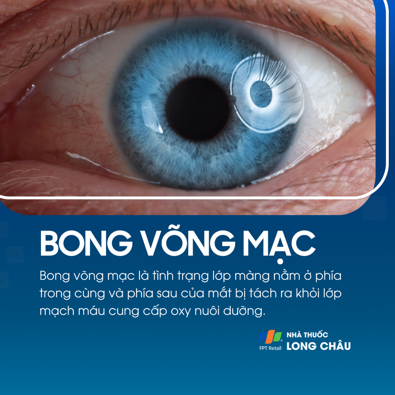 Tình trạng tách lớp võng mạc khỏi mạch máu phía sau mắt – nguy cơ mất thị lực