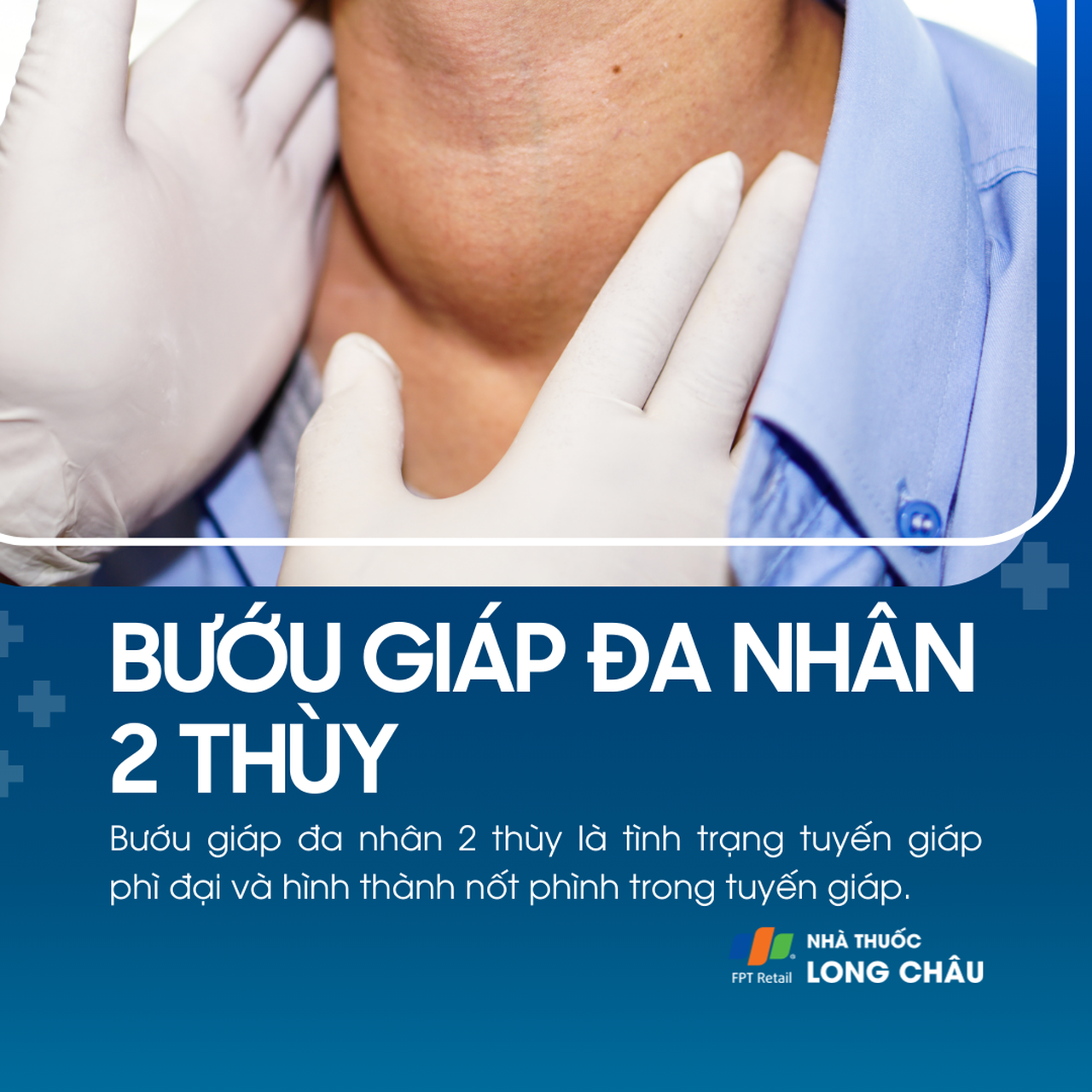 Bướu giáp đa nhân 2 thùy 1