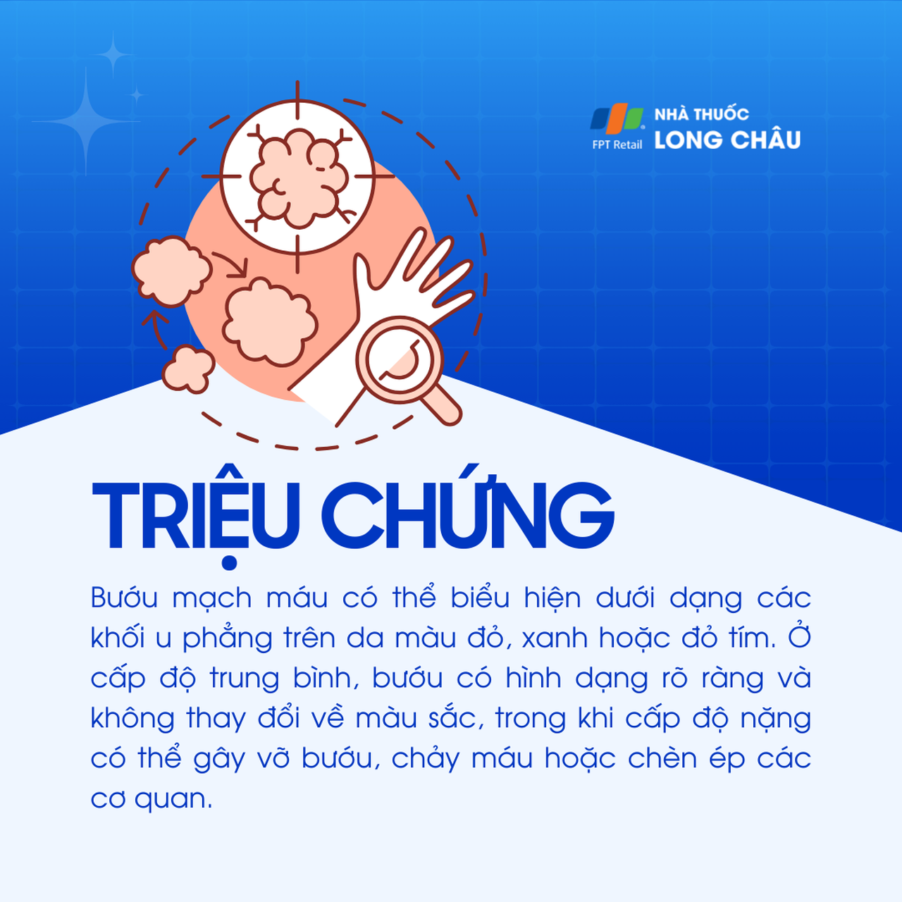 Bướu mạch máu 2