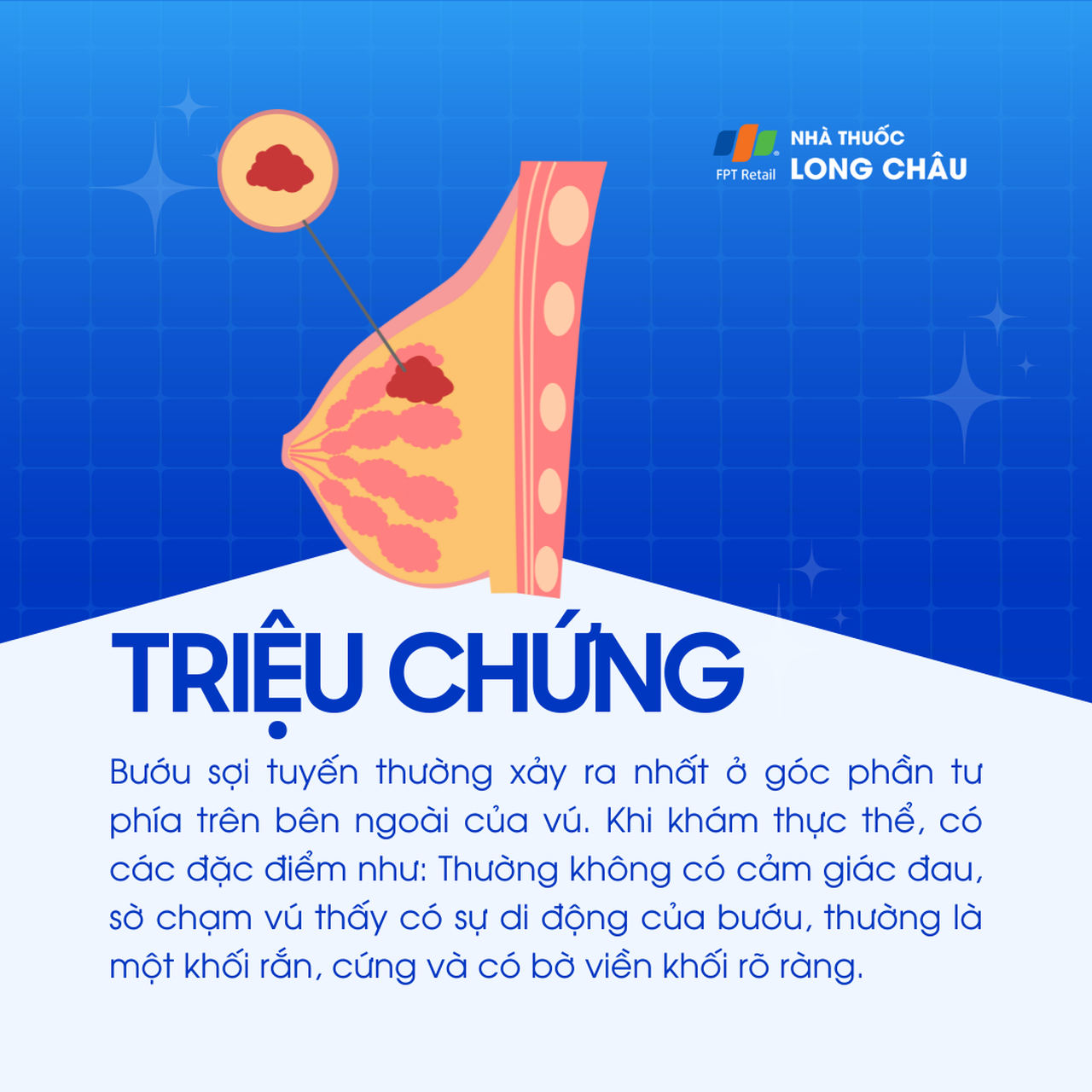 Bướu sợi tuyến vú Birads 3 2