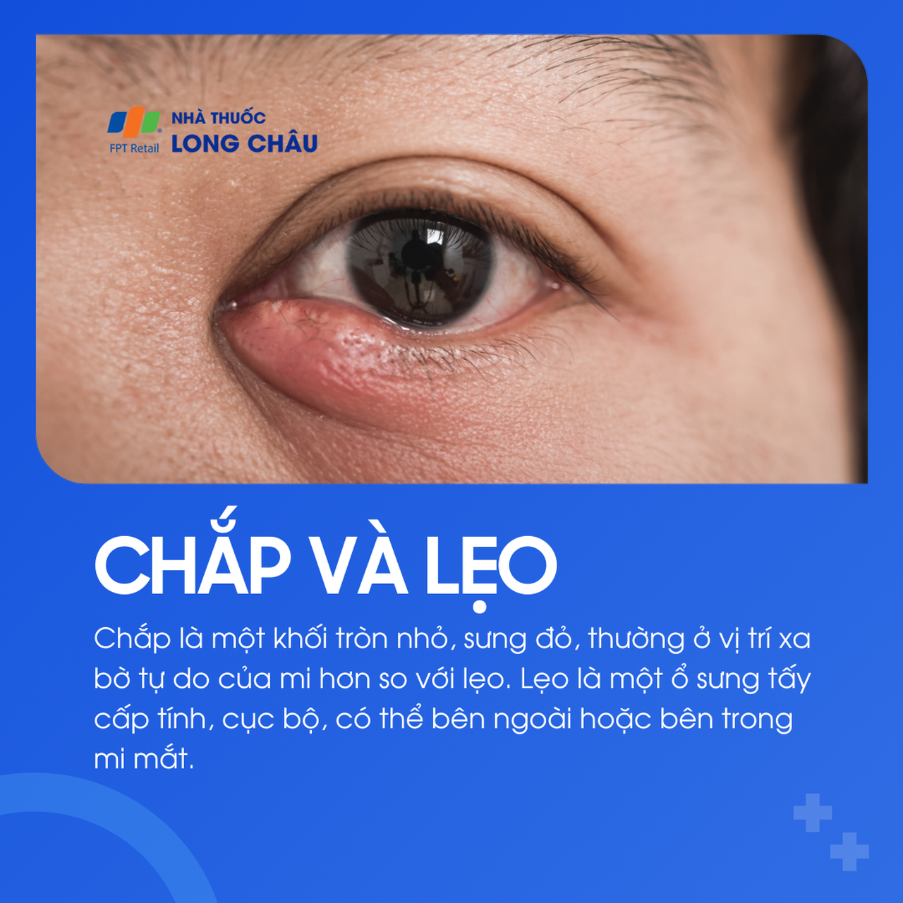 Chắp là khối tròn nhỏ, không nhiễm trùng. Lẹo là ổ viêm cấp tính, có thể bên trong hoặc bên ngoài mí mắt