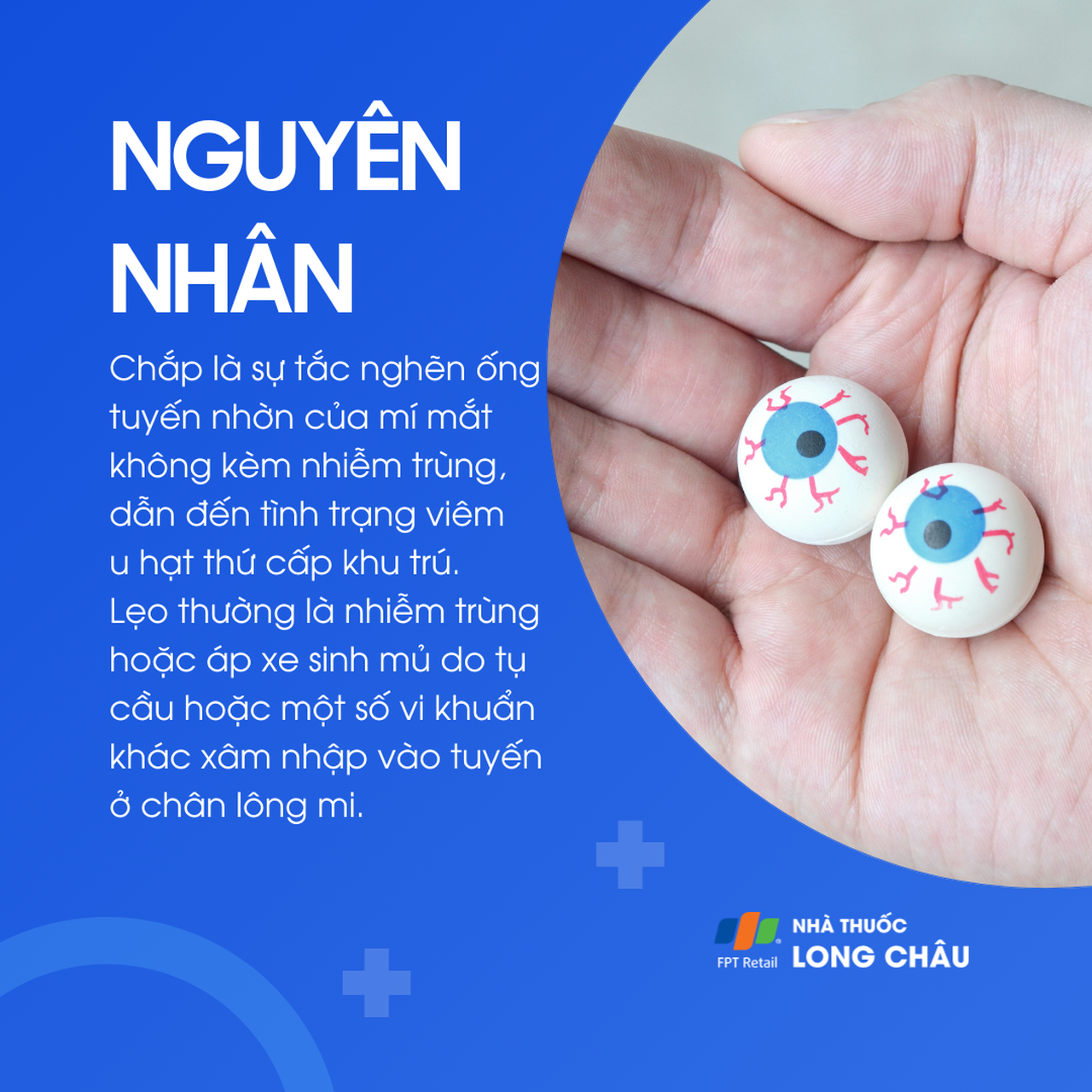 Chắp do tắc tuyến nhờn, không nhiễm trùng. Lẹo do vi khuẩn gây viêm, thường là tụ cầu khuẩn