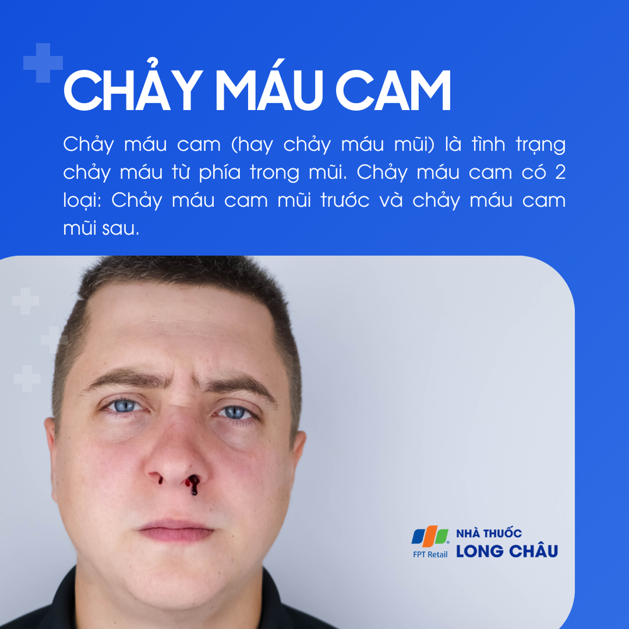 Chảy máu cam là tình trạng máu chảy ra từ mũi, thường chia thành chảy máu mũi trước và sau