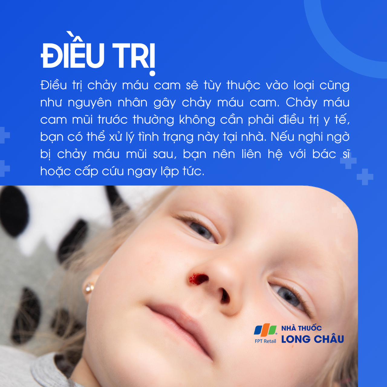 Với máu cam mũi trước, bạn có thể xử lý tại nhà. Máu mũi sau cần khám ngay nếu nghi ngờ nặng