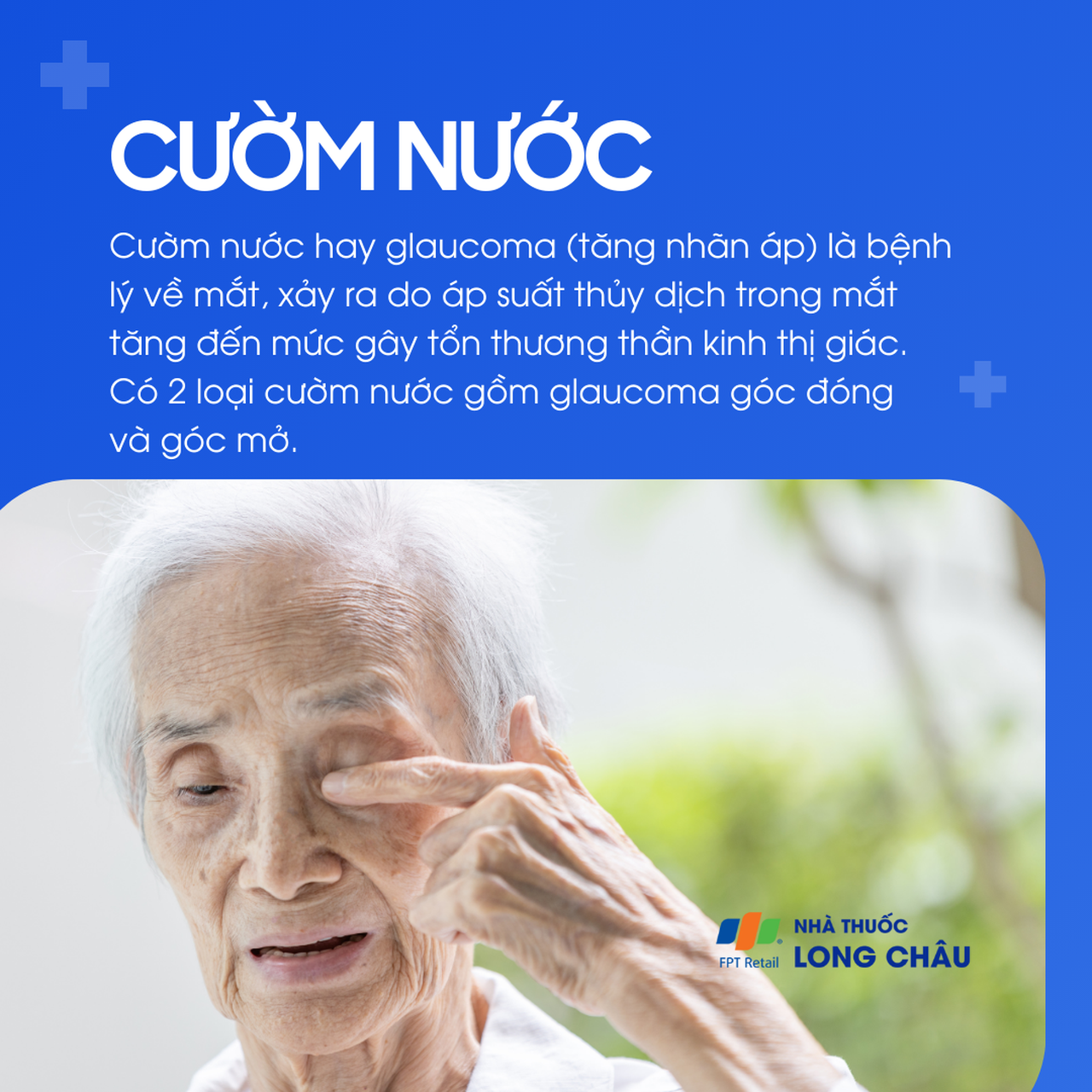 Cườm nước là bệnh lý về mắt do tăng nhãn áp, có thể gây tổn thương thần kinh thị giác nếu không điều trị sớm