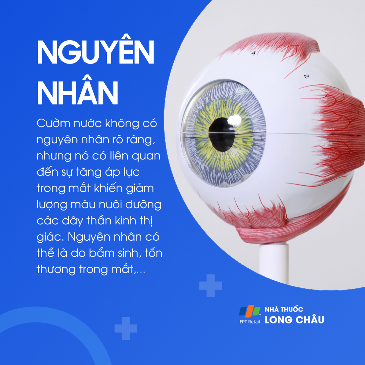 Cườm nước thường liên quan đến áp lực trong mắt tăng cao, làm giảm máu nuôi dưỡng dây thần kinh thị giác