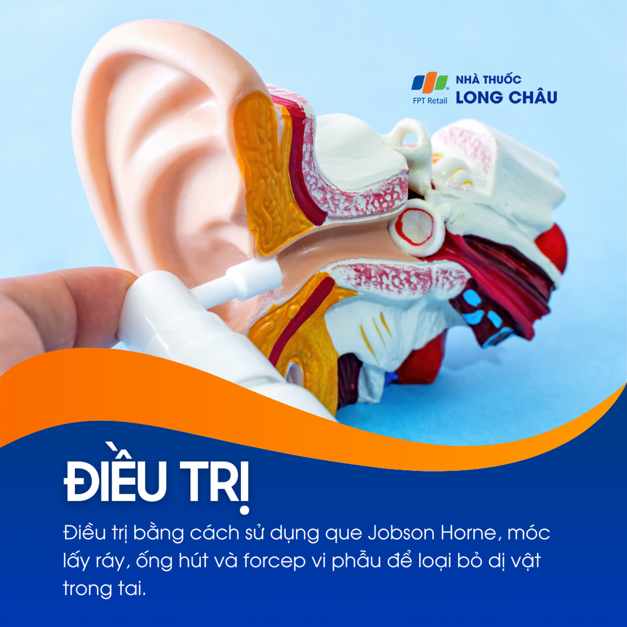 Dị vật trong tai 6