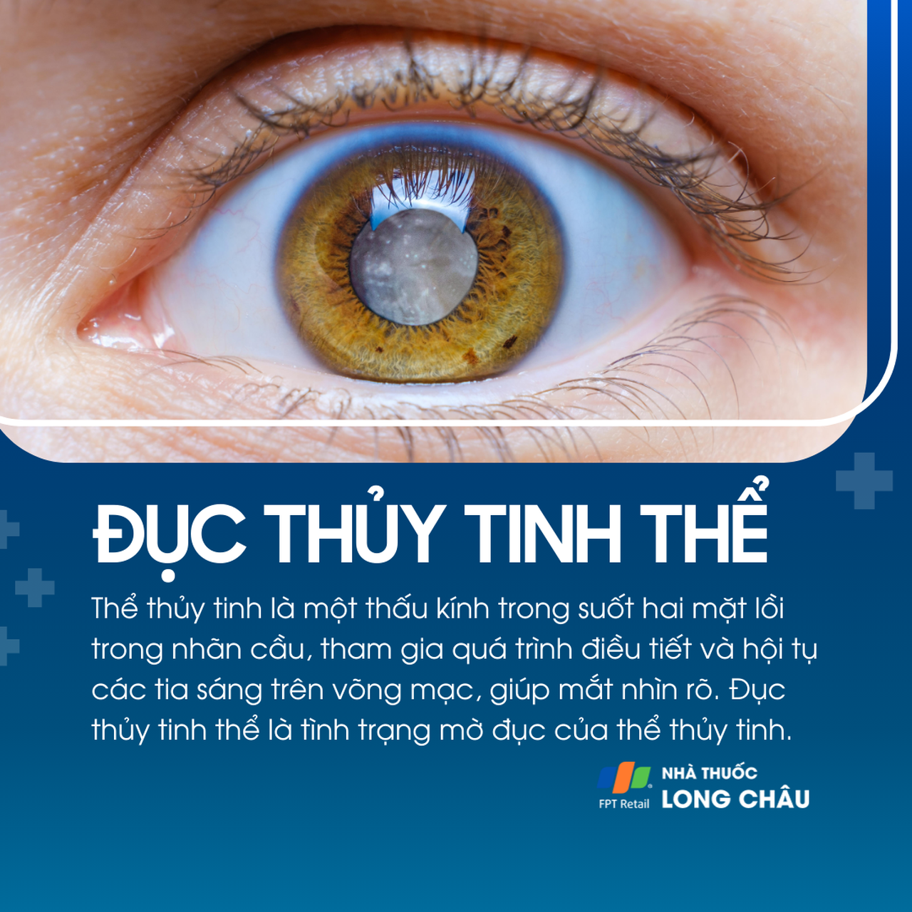 Đục thủy tinh thể 1