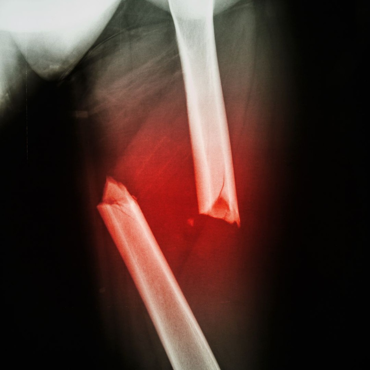 Gãy cổ xương đùi 1