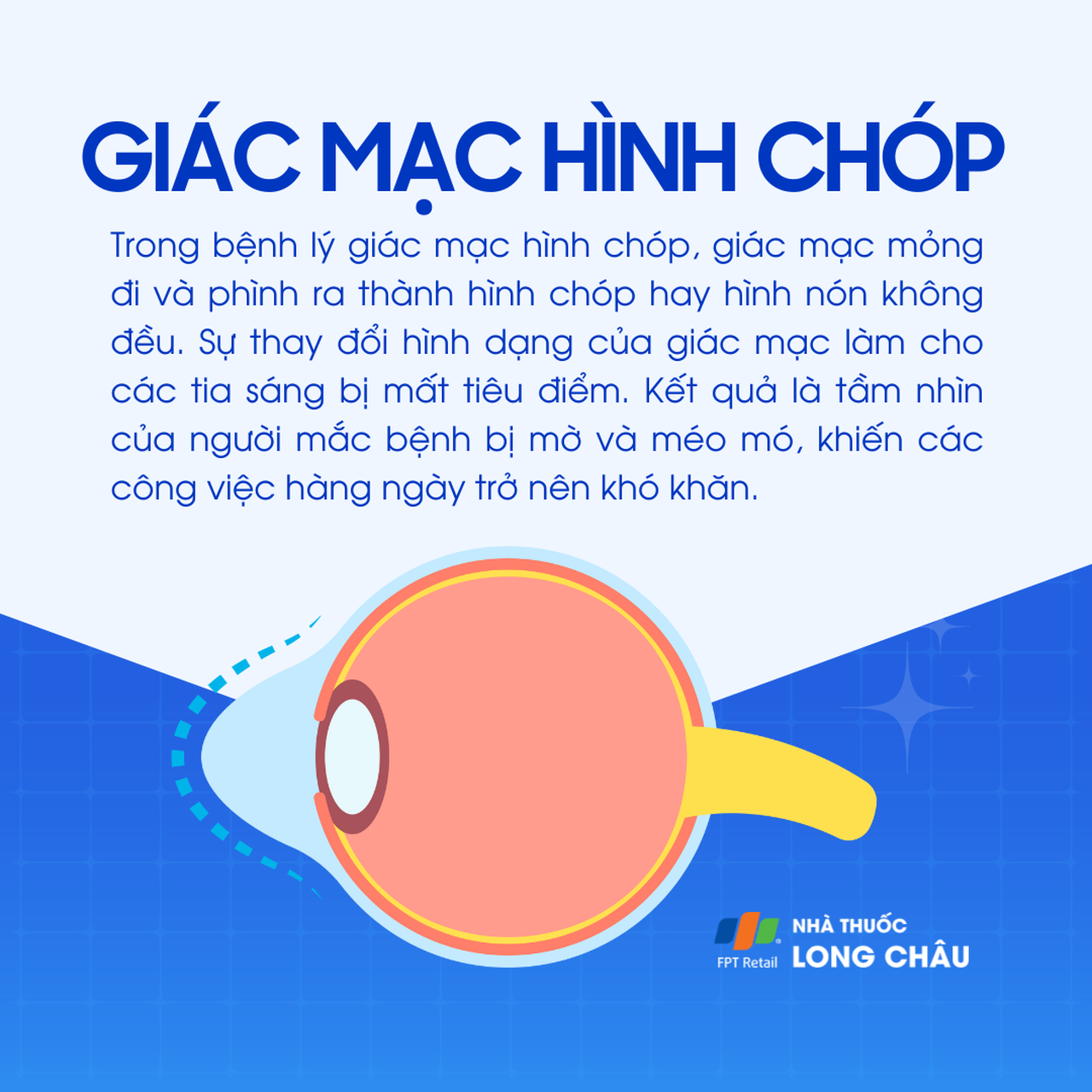 Giác mạc hình chóp 1