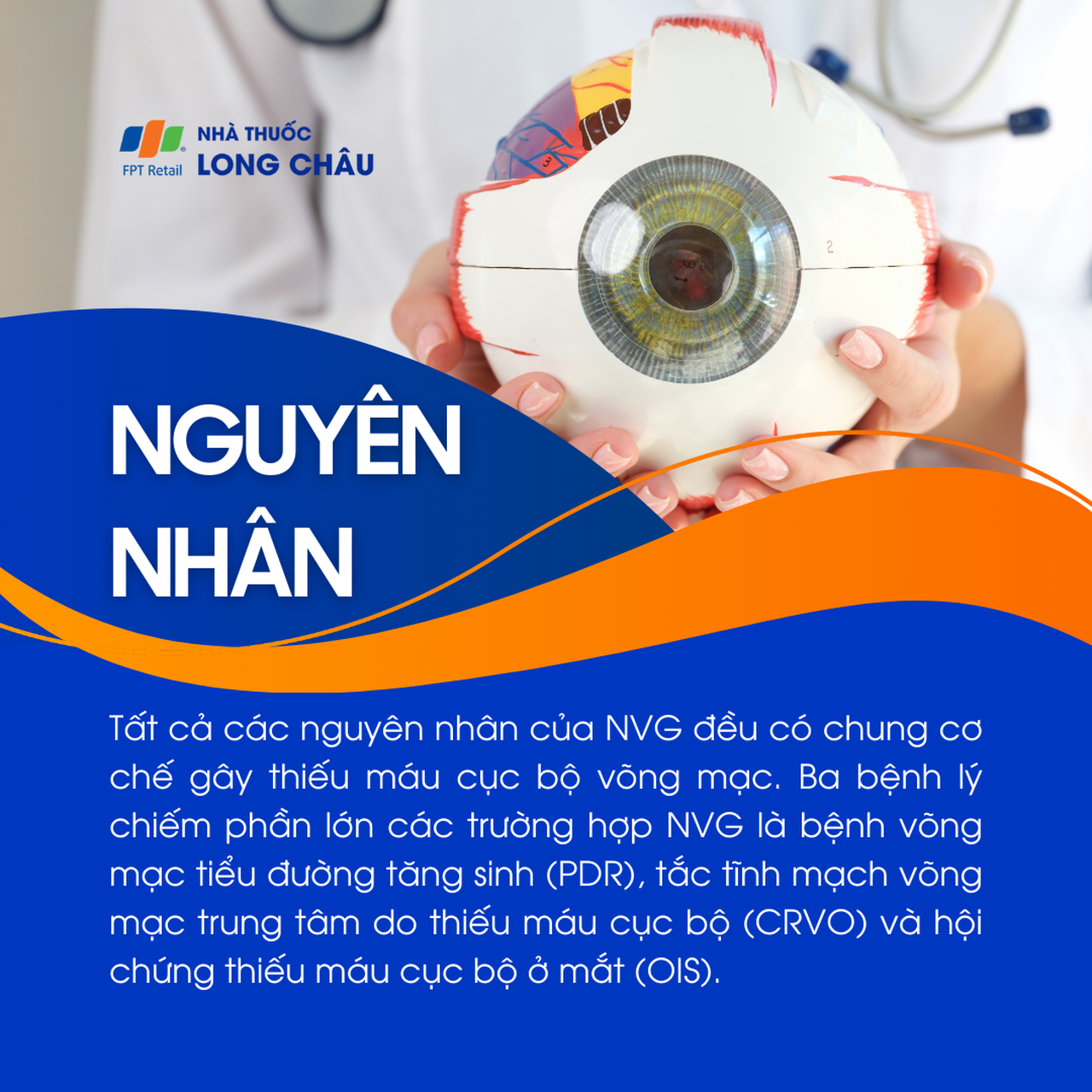 Glocom tân mạch 3