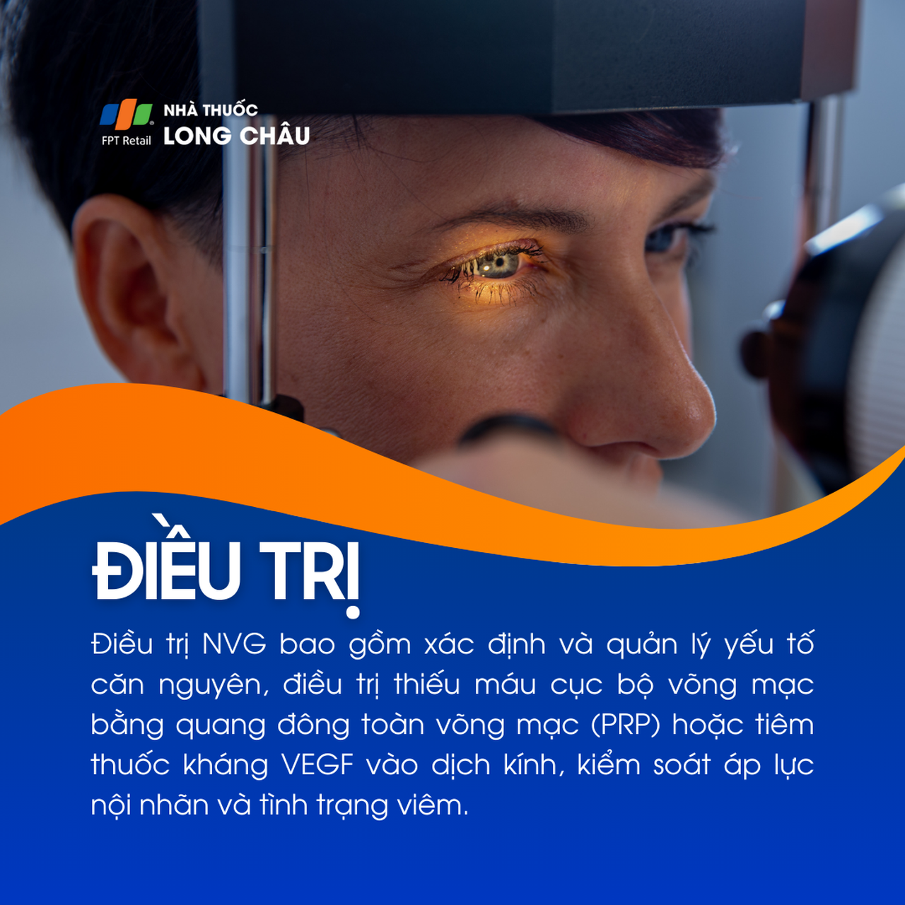 Glocom tân mạch 6