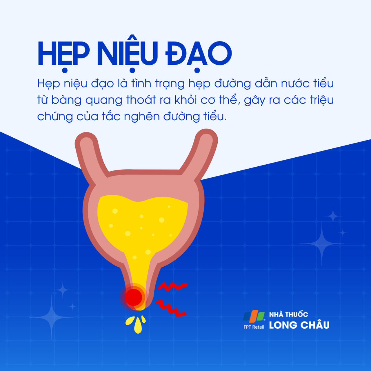 Hẹp niệu đạo 1