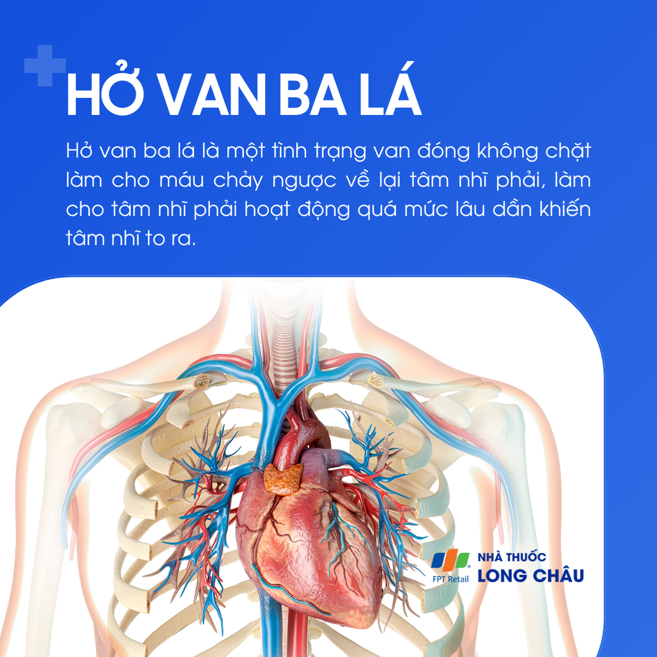 Hở van ba lá 1