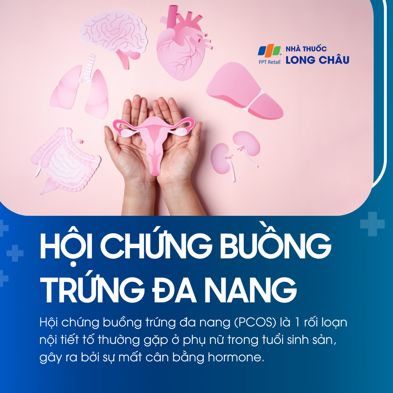 Hội chứng buồng trứng đa nang 1