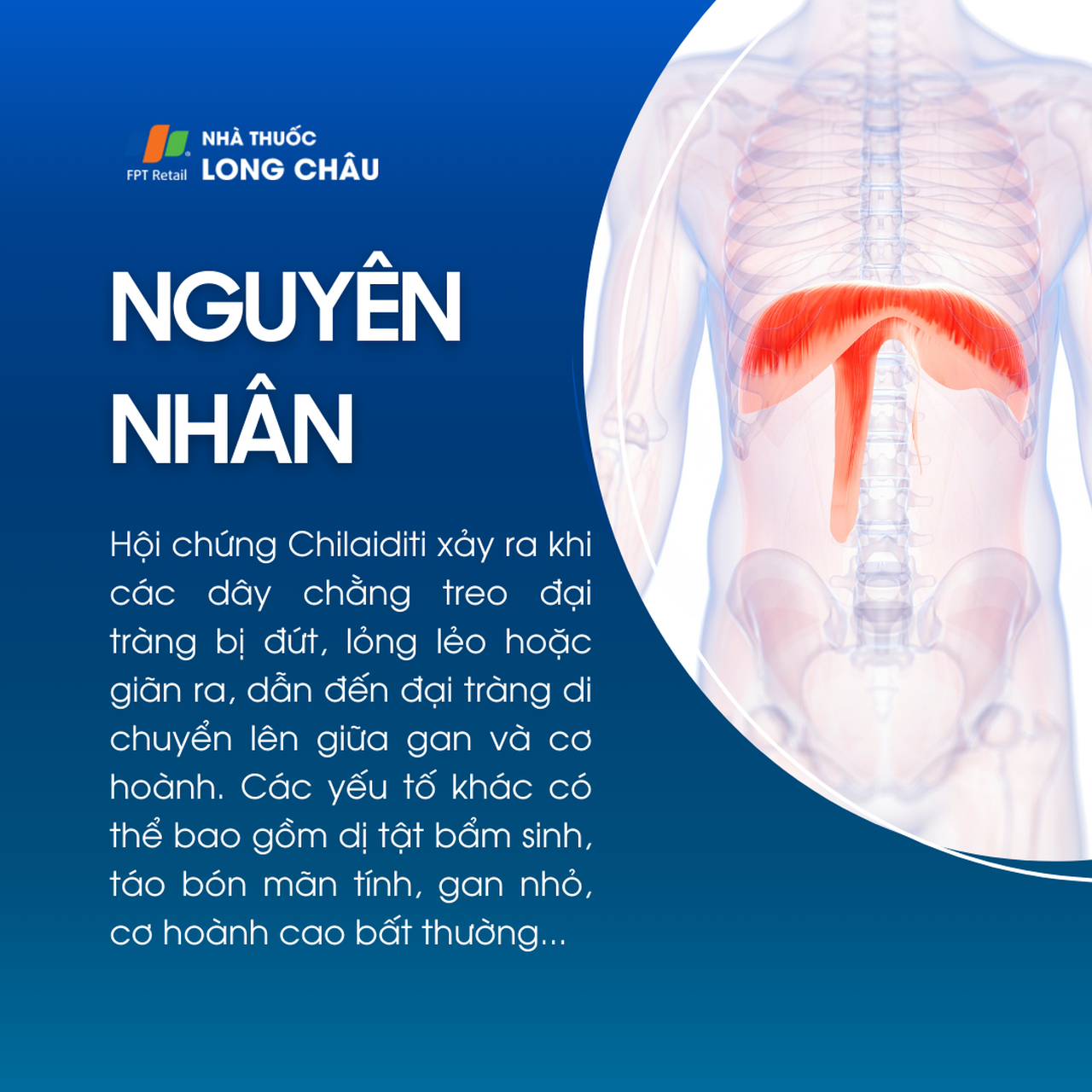 Hội chứng Chilaiditi 3