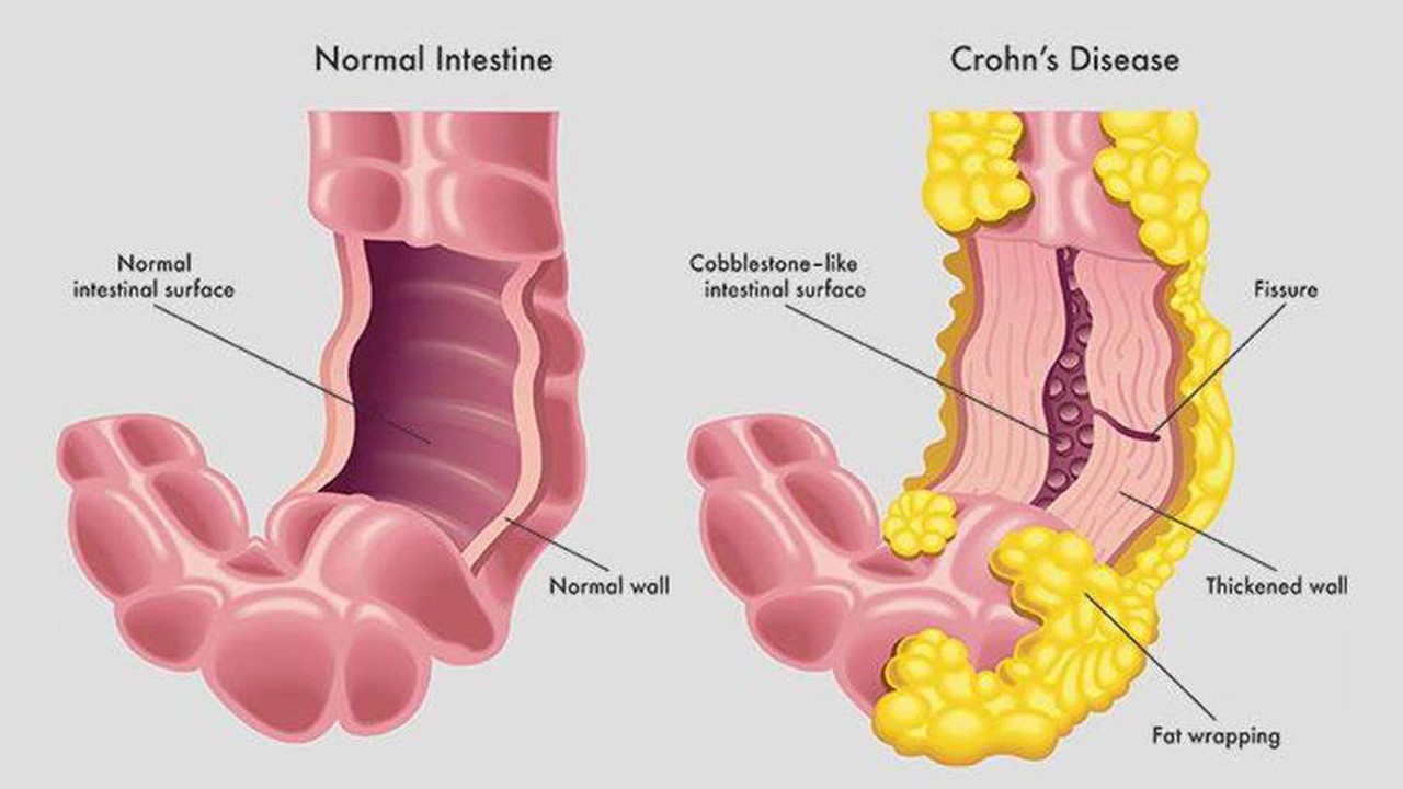 Bệnh Crohn: Nguyên nhân, triệu chứng, phương pháp điều trị 1