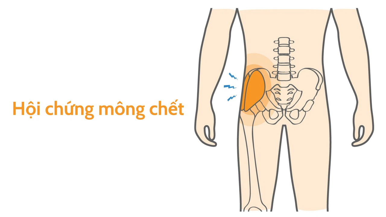  Hội chứng mông chết: Nguyên nhân, điều trị và cách phòng ngừa s1