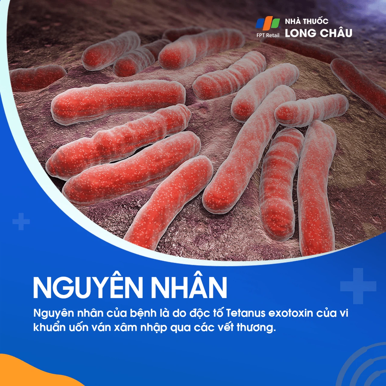 Vết thương bị nhiễm trùng Clostridium tetani, vi khuẩn gây ra bệnh uốn ván, thường xảy ra ở những vùng không sạch sẽ