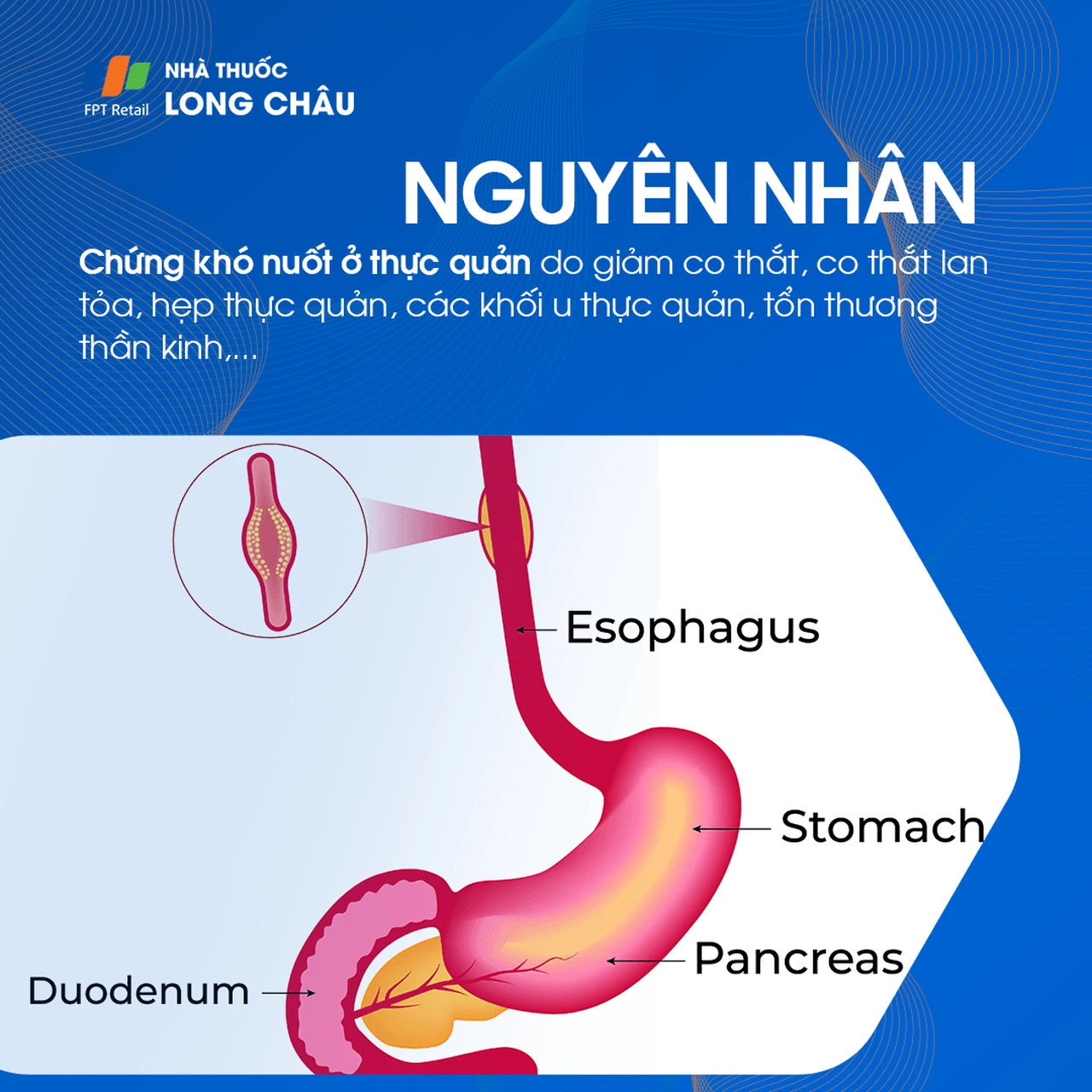 Chứng khó nuốt 