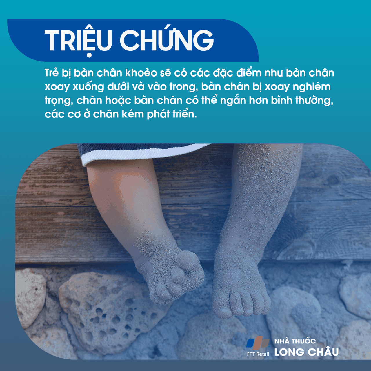 Bàn Chân Khoèo 2