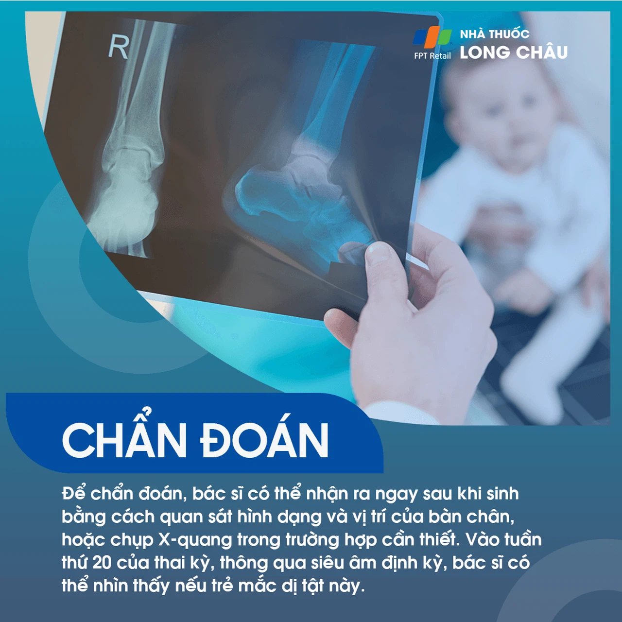 Bàn Chân Khoèo 5