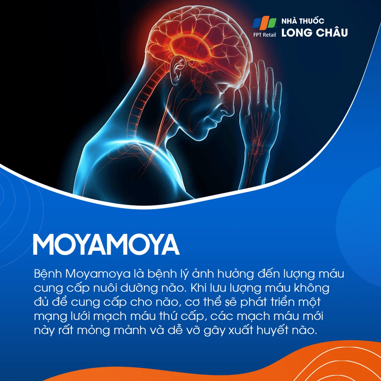 Bệnh moyamoya 1