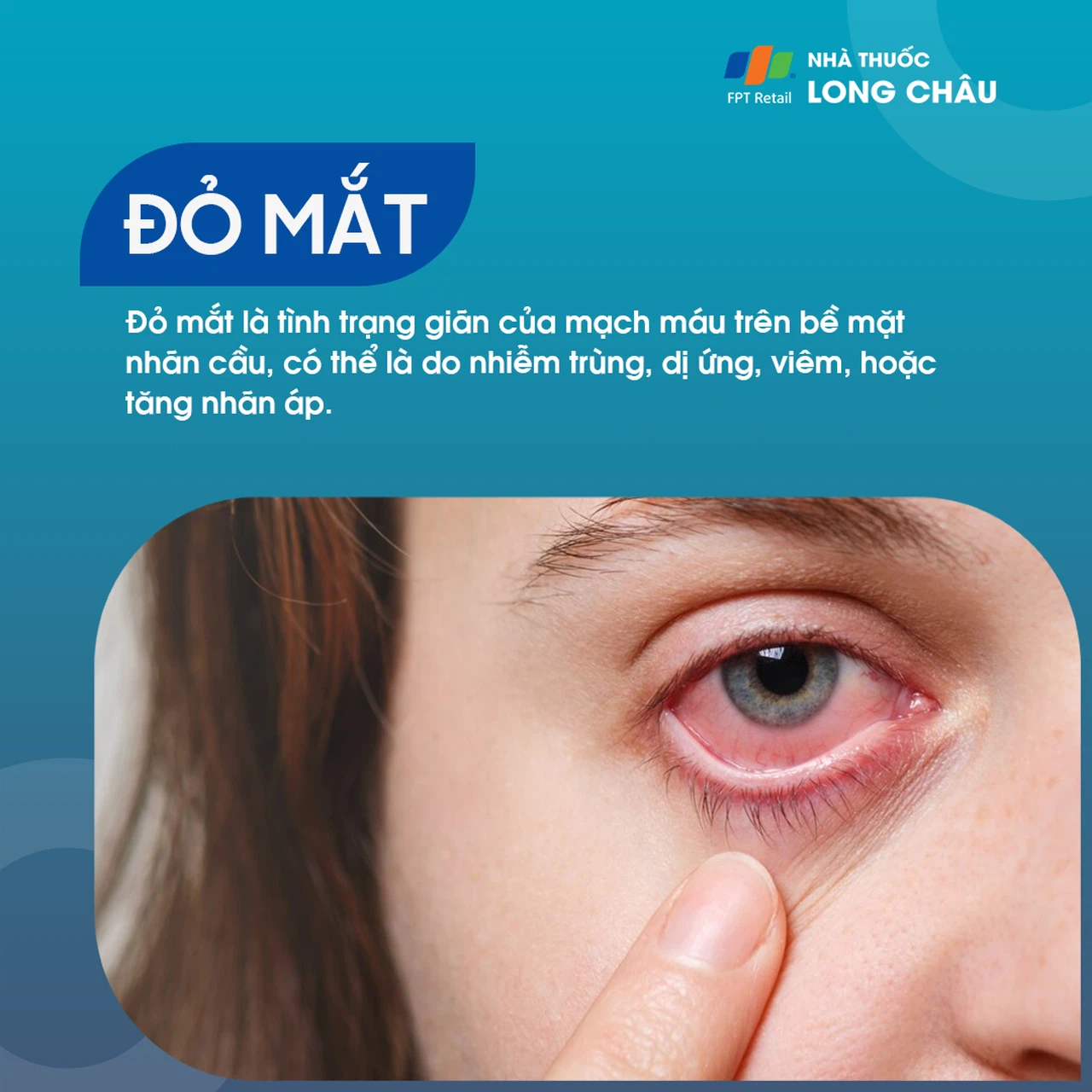 Mắt đỏ 1