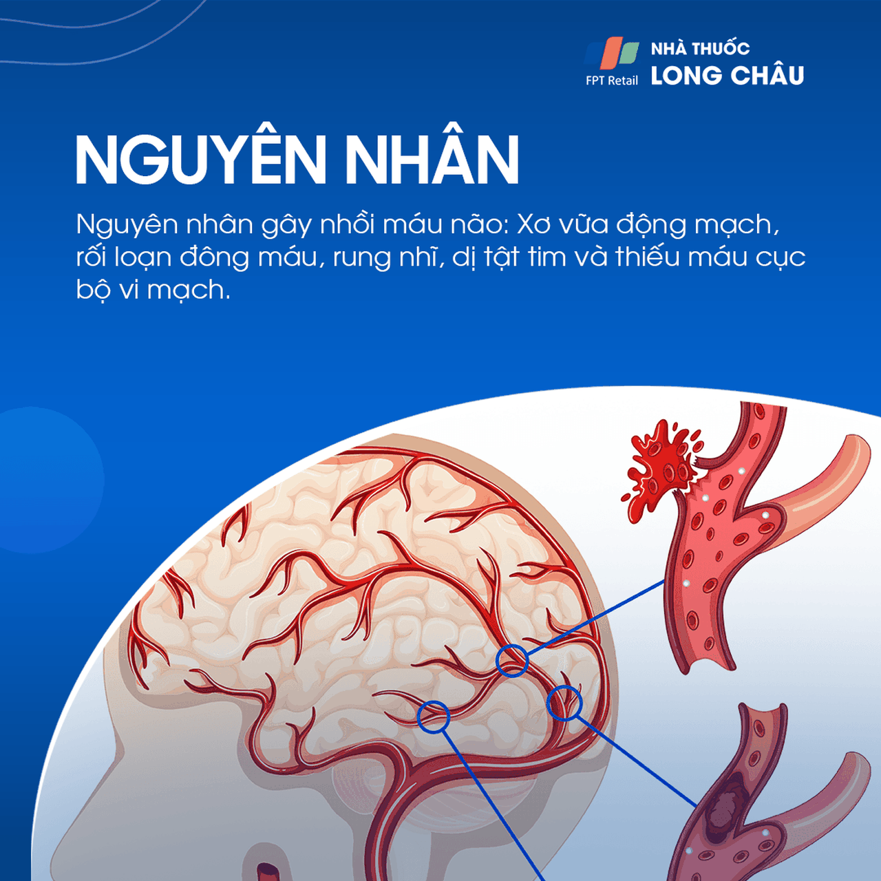 Đột quỵ não 3
