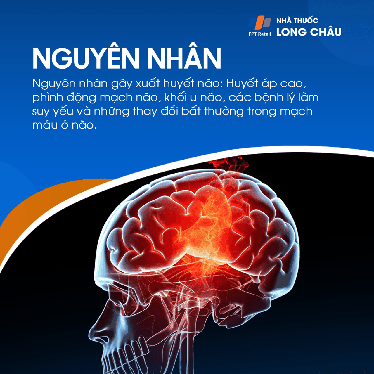 Đột quỵ não 4