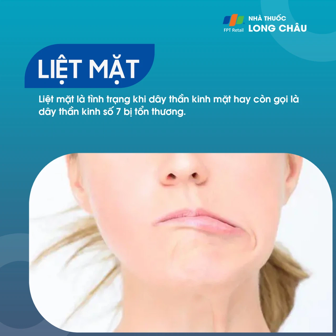 Liệt mặt 1