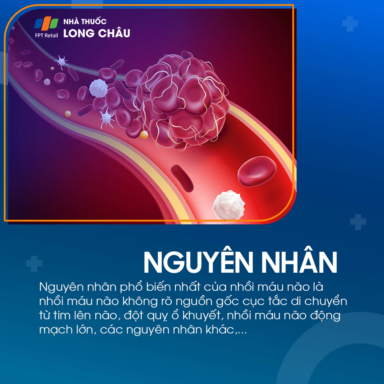 Nguyên nhân gây bệnh nhồi máu não chủ yếu do tắc nghẽn mạch máu trong nã