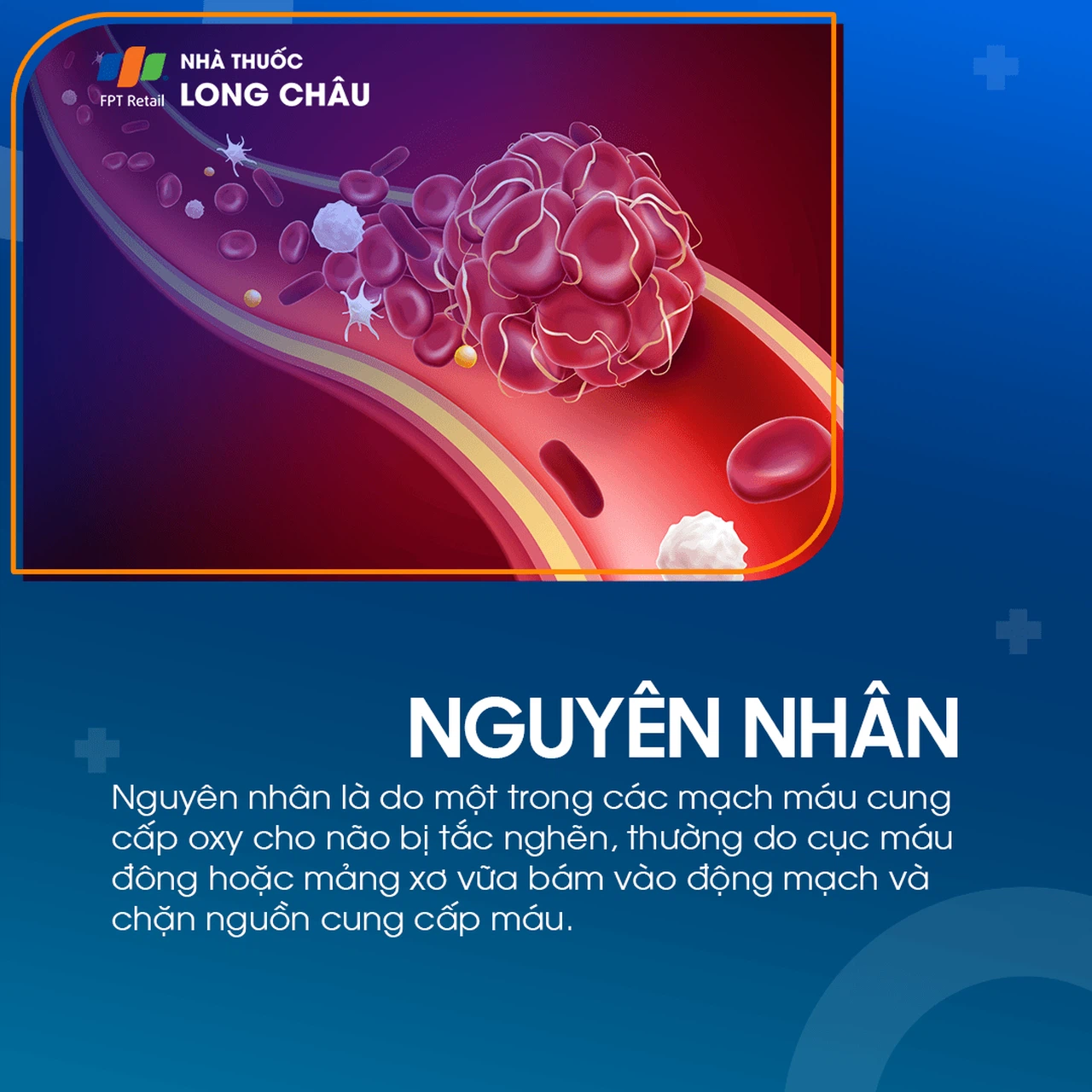 Cơn thiếu máu não cục bộ thoáng qua 3