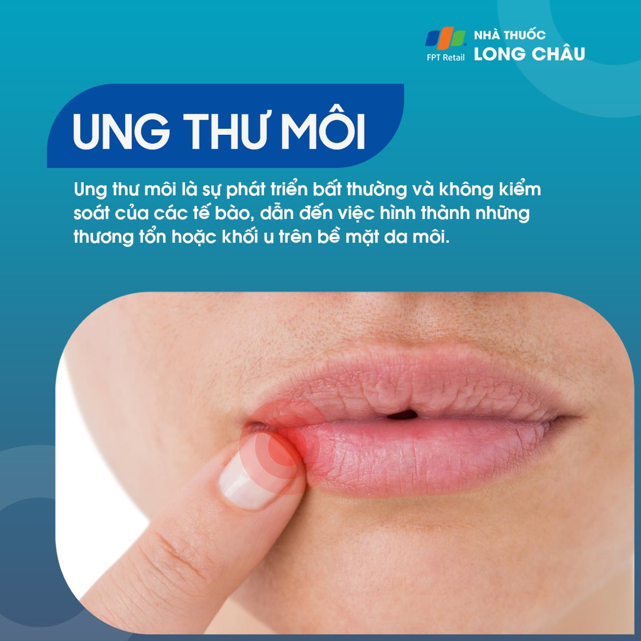 Ung thư môi 1