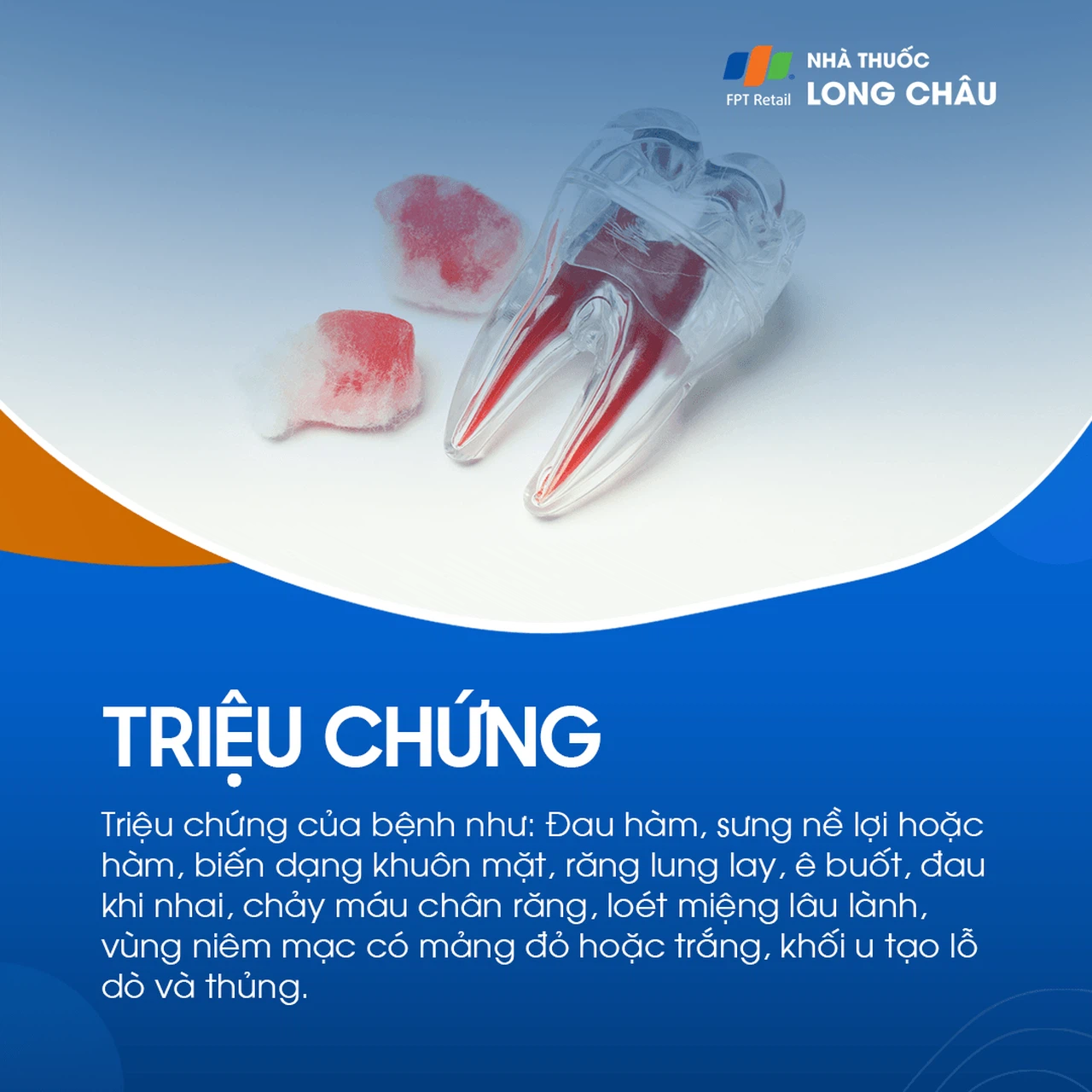 U xương hàm 2